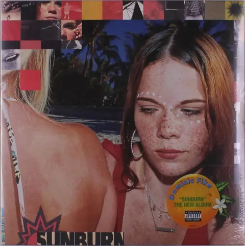 Sunburn
